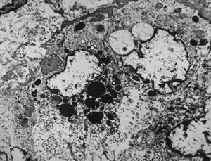 M,61y. | spleen - hemangioma v.s. … erythrophagocytosis M,61y. | spleen - hemangioma v.s. … erythrophagocytosis